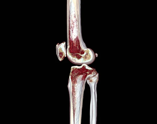 膝关节三维扫描的半Ct扫描在黑色背景下分离诊断膝关节骨折 — 图库照片