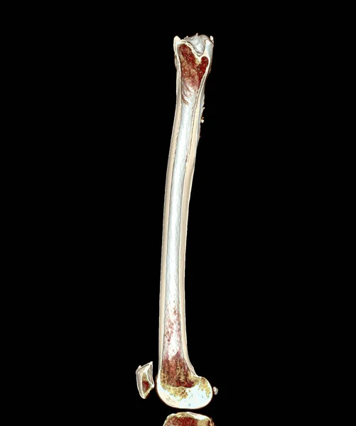 Scan Femur Thigh Bone Rendering Image Isolated Black Background Diagnosis — Fotografia de Stock