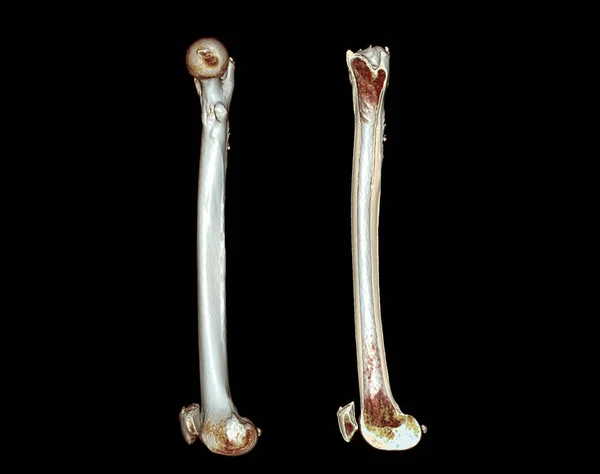 Scan Femur Thigh Bone Rendering Image Isolated Black Background Diagnosis — Fotografia de Stock