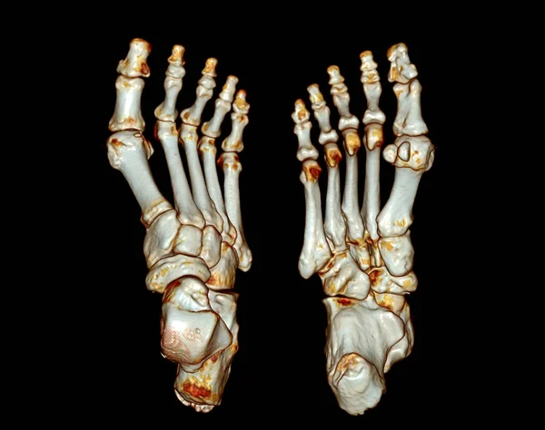 Foot Hesaplanmış Tomografisi Ses Ayarı Taraması Foot Görüntüleme — Stok fotoğraf