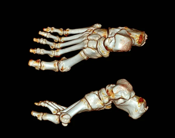 足部电脑断层扫描 足部三维体积渲染检查 Vr脚部 3D渲染 — 图库照片