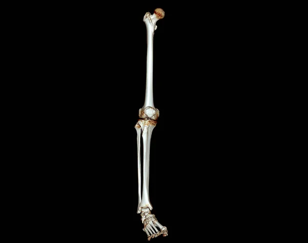 下肢三维Ct扫描诊断股骨 膝关节 脚三维重建骨折 — 图库照片