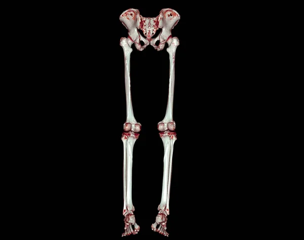 大腿骨骨骨折 膝関節 足と足の3Dレンダリングの診断のための下極限3DのCtスキャン — ストック写真