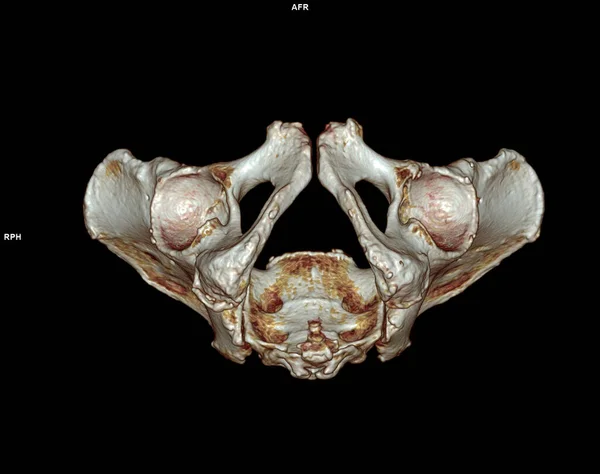 CT scan of Pelvic bone and hip joint 3D rendering for diagnosis fracture of Pelvic bone and hip joint isolated on white background.