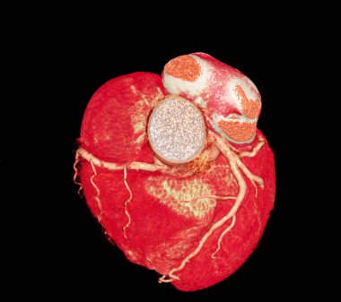 Koroner arter hastalıklarının önlenmesi için CT 3D veya CTA koroner arteri.