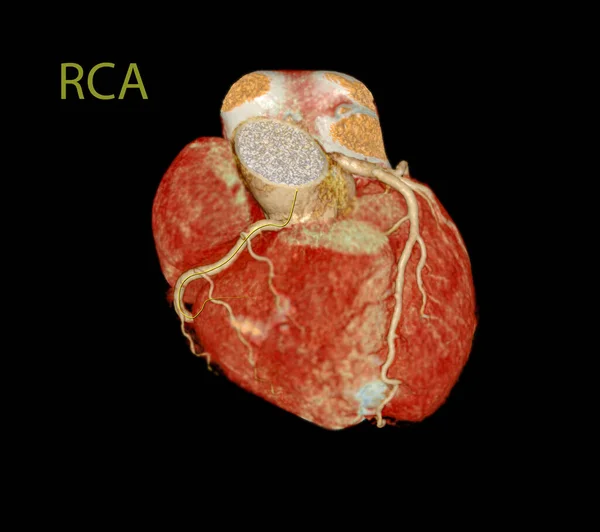 Cardiac Cta Arteria Coronaria Para Prevención Enfermedades Las Arterias Coronarias —  Fotos de Stock