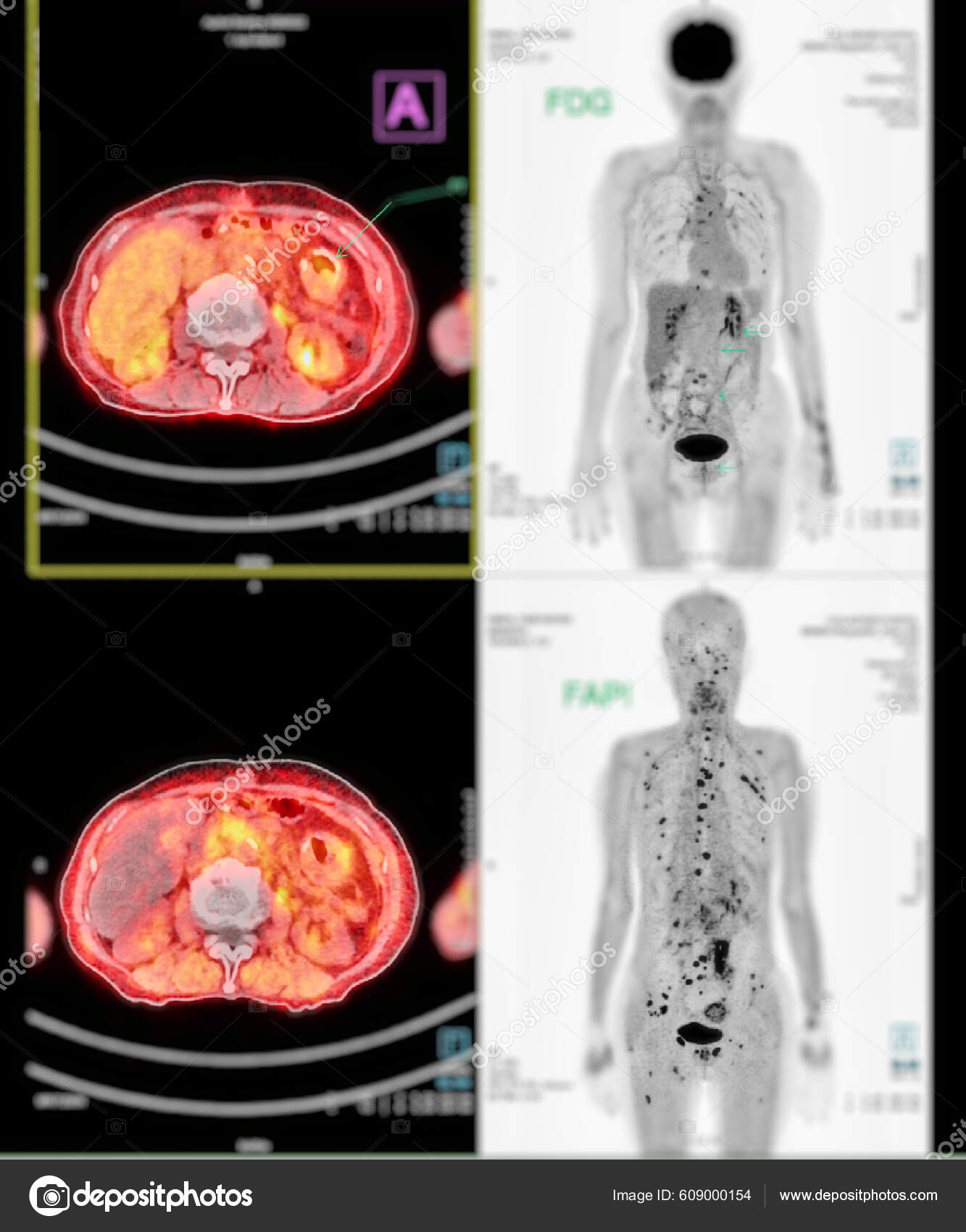 Pet 촬영은 방사선 트레이서 사용하여 재발을 탐지하기 전체의 정상적 비정상적 — 스톡 사진 © samunella #609000154