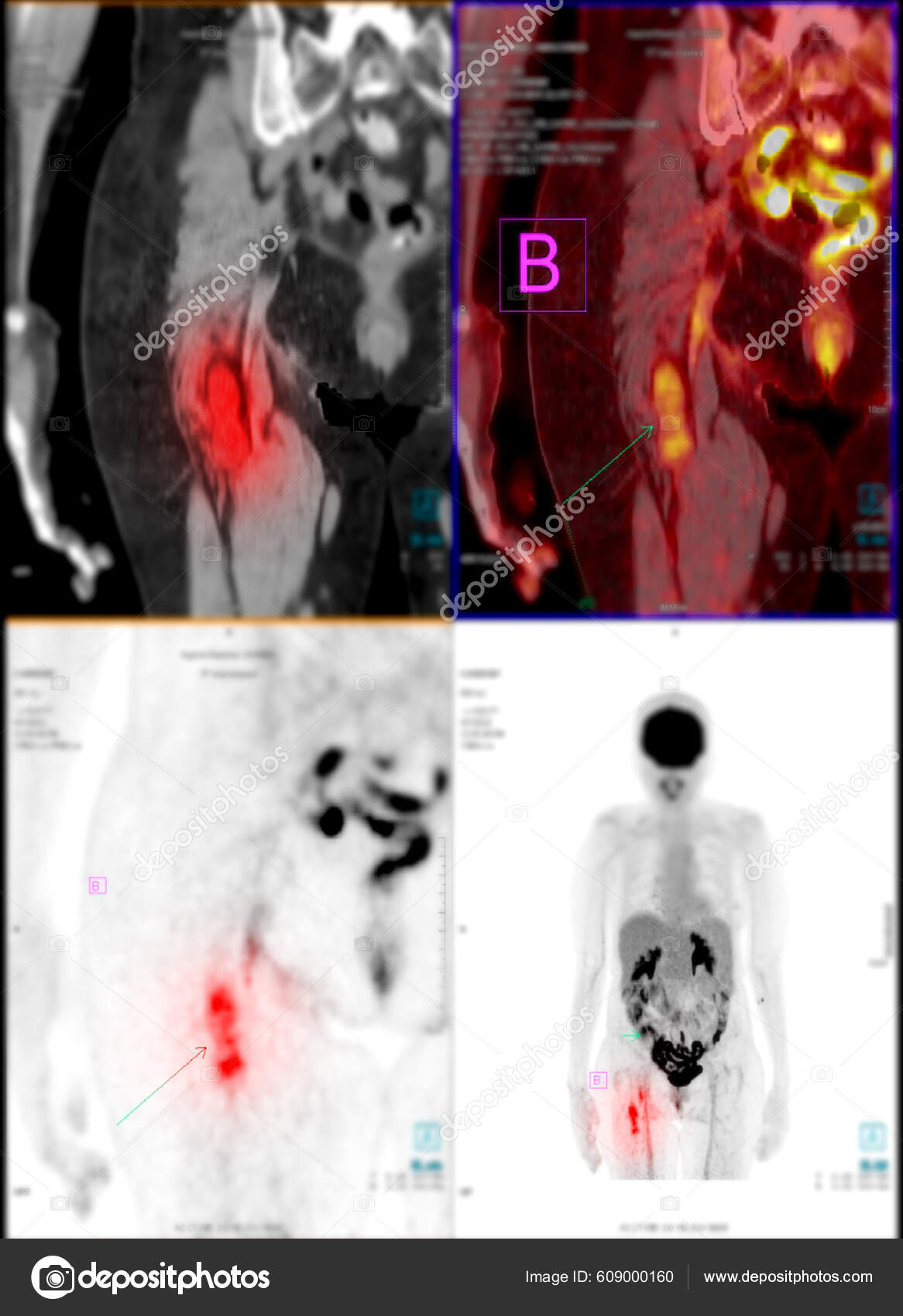 Pet 촬영은 방사선 트레이서 사용하여 재발을 탐지하기 전체의 정상적 비정상적 — 스톡 사진 © samunella #609000160