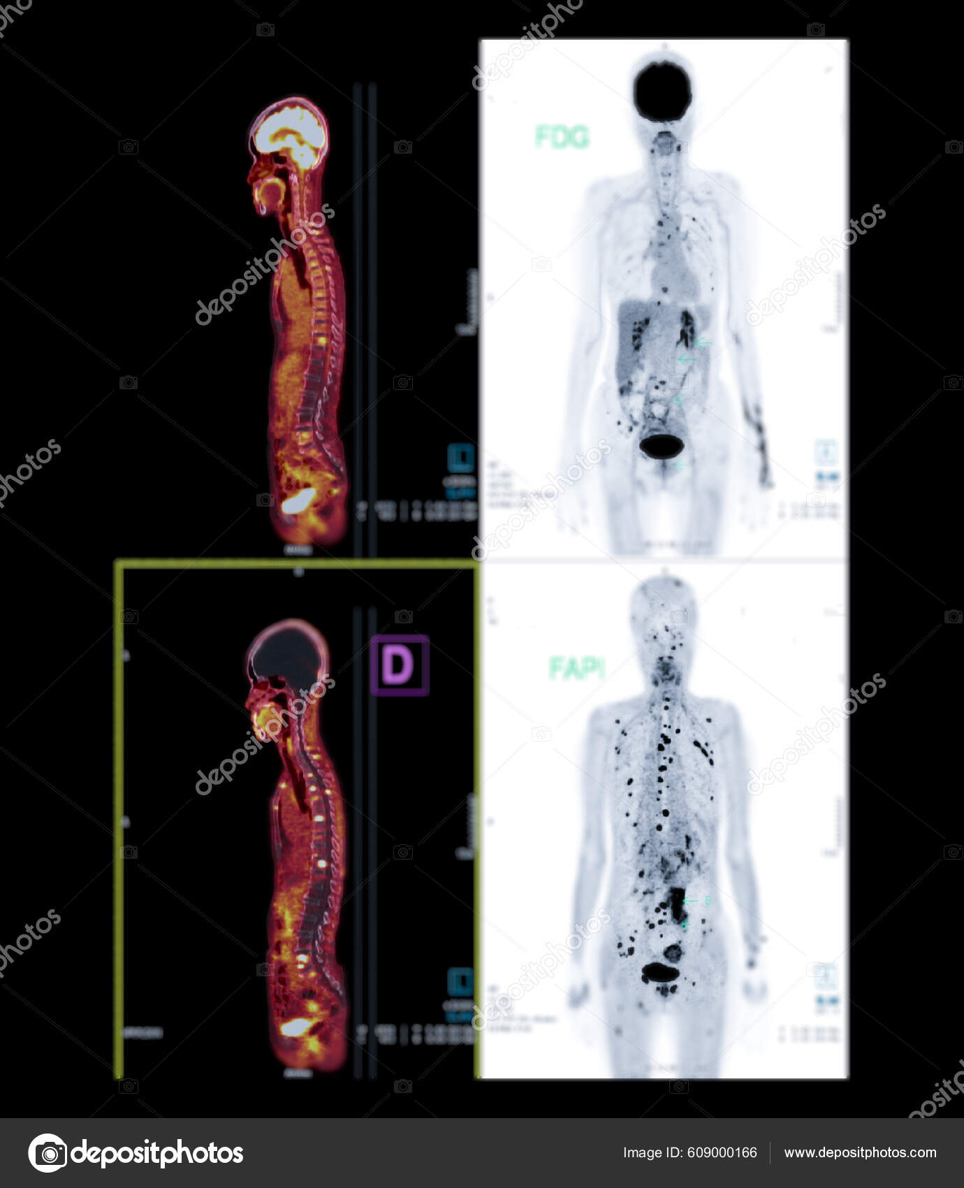 Positron Emission Tomography Pet Scan Uses Radioactive Drug Tracer Show ...