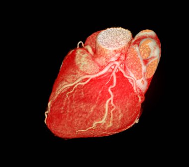 Koroner arter hastalıklarının önlenmesi için CT 3D veya CTA koroner arteri.