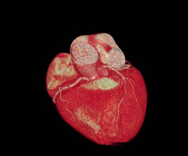 Koroner arter hastalıklarının önlenmesi için CT 3D veya CTA koroner arteri.