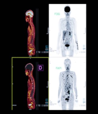 Pozitron emisyon tomografisi (PET) CT taraması, ameliyattan sonra kanser nüksetmesini tespit etmek için tüm insan vücudunun normal ve anormal metabolik aktivitelerini gösteren radyoaktif bir ilaç (izleyici) kullanır. .