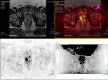 Pozitron emisyon tomografisi (PET) CT taraması, ameliyattan sonra kanser nüksetmesini tespit etmek için tüm insan vücudunun normal ve anormal metabolik aktivitelerini gösteren radyoaktif bir ilaç (izleyici) kullanır. .
