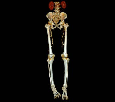 CTA uyluk atardamarı akut ya da kronik çevresel atardamar rahatsızlığı olan femoral arterin görüntüsünü veriyor..