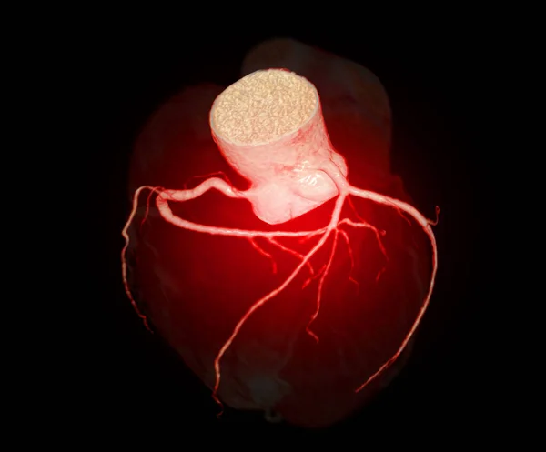 Ct心脏3D或Cta冠状动脉预防冠心病 — 图库照片