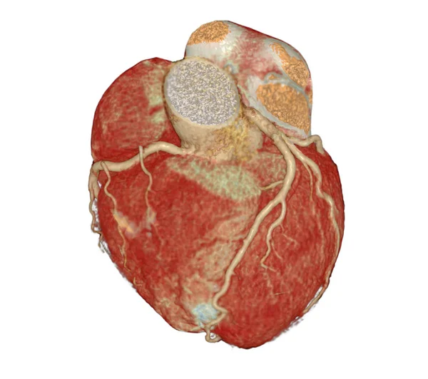 Cardiac Artéria Coronária Cta Para Prevenção Doenças Coronarianas — Fotografia de Stock