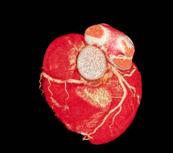 Ct心脏3D或Cta冠状动脉预防冠心病 — 图库照片