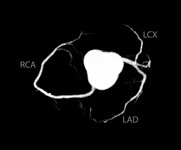 Cardiac Cta Arteria Coronaria Para Prevención Enfermedades Las Arterias Coronarias —  Fotos de Stock