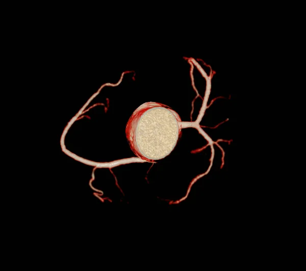 Cardiac Cta Коронарной Артерии Профилактики Заболеваний Коронарной Артерии — стоковое фото