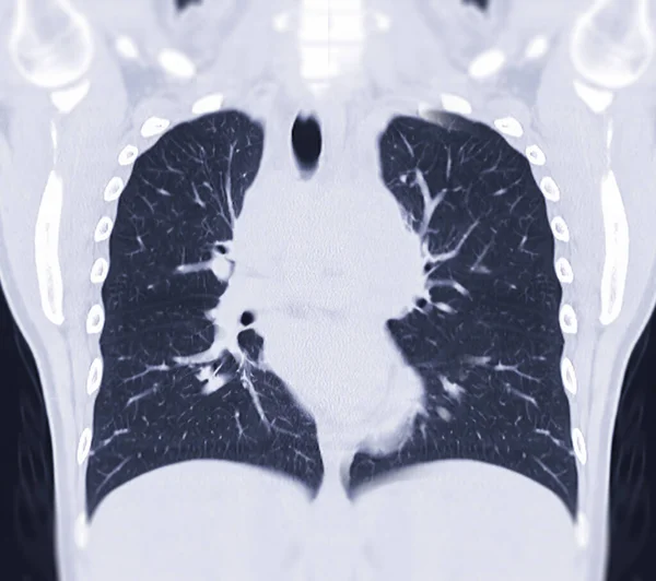 Mellkas Coronal Mip Nézet Diagnosztikai Tüdőembólia Tüdőrák Covid — Stock Fotó