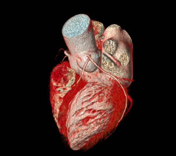 冠動脈疾患予防のためのCt心臓3DまたはCta冠動脈 — ストック写真