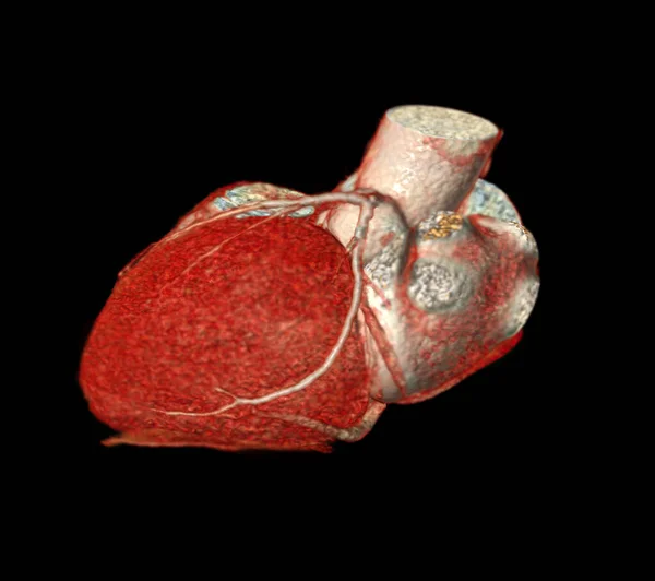 Cardiac Oder Cta Koronare Arterie Zur Prävention Koronarer Herzkrankheiten — Stockfoto