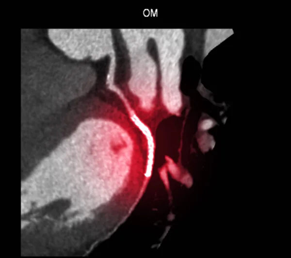 Cardiale Cta Coronaire Slagader Toont Stompe Marginale Takken Met Stent — Stockfoto