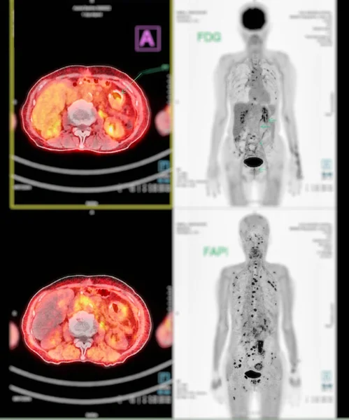 正电子发射断层扫描 Pet Ct扫描使用放射性药物 示踪剂 来显示整个人体正常和异常的代谢活动 以检测术后癌症复发 — 图库照片