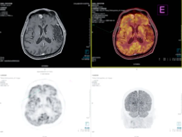 Positron Emissie Tomografie Pet Scan Maakt Gebruik Van Een Radioactief — Stockfoto