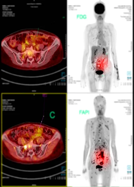 Pozitronová Emisní Tomografie Pet Scan Používá Radioaktivní Lék Stopovací Látka — Stock fotografie