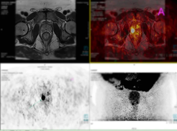 ポジトロン放射線トモグラフィー Pet Ctスキャンは放射性医薬品 トレーサー を使用して 手術後のがん再発を検出するための人体全体の正常および異常な代謝活動の両方を示します — ストック写真