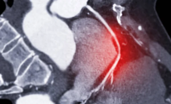 Artéria Coronária Cardíaca Atc Mostrando Artéria Coronária Direita Com Substituição — Fotografia de Stock