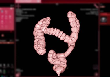 Kolon kanseri ve kolorektal kanser teşhisi için CT kolonografisi veya CT kolonografisi 3D görüntüleme .