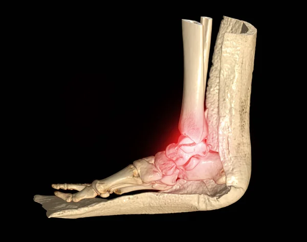 Scan Tornozelo Tomografia Computadorizada Articulação Tornozelo Volume Imagem Renderização Mostrando — Fotografia de Stock