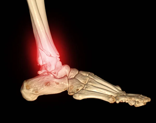 Ctスキャン足首や足や足首の関節や足の3Dボリュームレンダリング画像のコンピュータ断層撮影骨折の骨を示しています — ストック写真