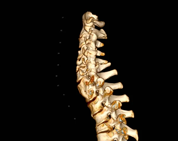 CT SCAN of Cervical Spine ( C-spine )  3D rendering image from patient trauma case.