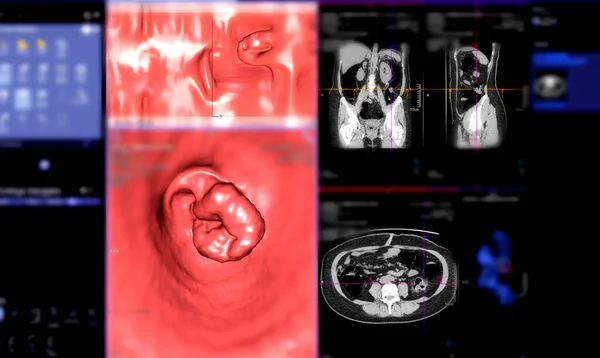 Ct大腸がんおよび大腸がんを診断するためのCt大腸がんまたはCt大腸がん3Dレンダリング画像 — ストック写真
