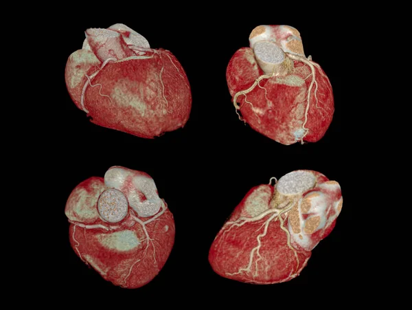 Cardiac Oder Cta Koronare Arterie Zur Prävention Koronarer Herzkrankheiten Isoliert — Stockfoto