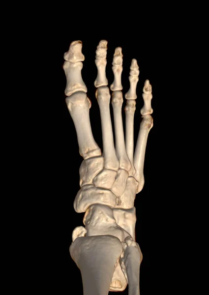 脚部Ct扫描或脚踝关节与足部三维体积显示腓骨骨折的计算机断层扫描 — 图库照片