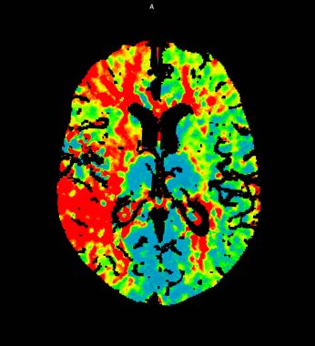 Axial view of CT Perusion of the brain  with contrast showing brain anatomy, lobes, perfusion and function. The red area indicates high brain activity, perfusion and function. clipart