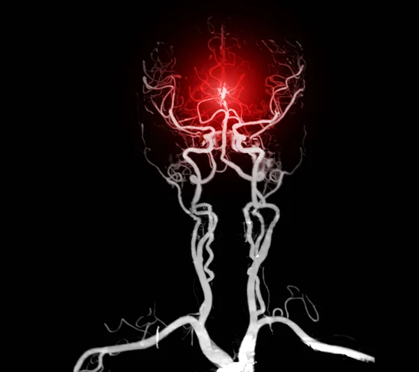 Cta Cerveau Angiographie Cerveau Image Rendu Pour Diagnostic Anévrisme Artère — Photo