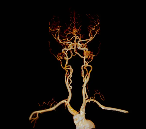 Cta Angiografía Cerebral Del Cerebro Imagen Renderización Para Diagnóstico Aneurisma — Foto de Stock