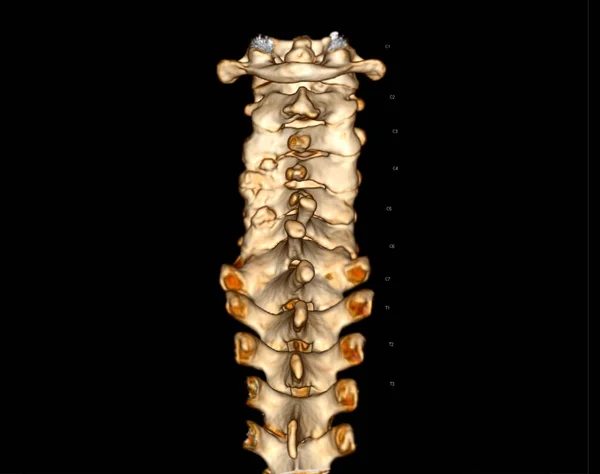 Scan Van Spine Cervicale Wervelkolom Rendering Voor Diagnose Fractuur Van — Stockfoto