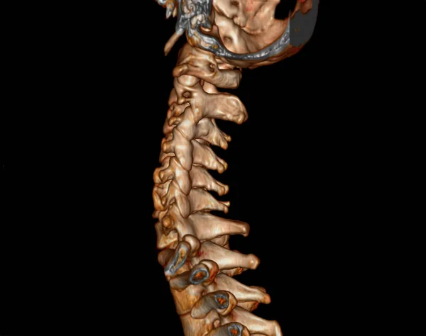 Tac Della Colonna Vertebrale Della Colonna Vertebrale Cervicale Rendering Diagnosi — Foto Stock