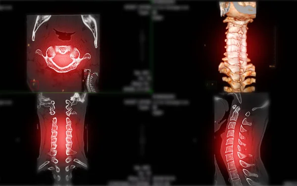 Collecion of CT scan of C-Spine or Cervical spine 3D rendering  for diagnosis  fracture of cervical spine in case trauma.