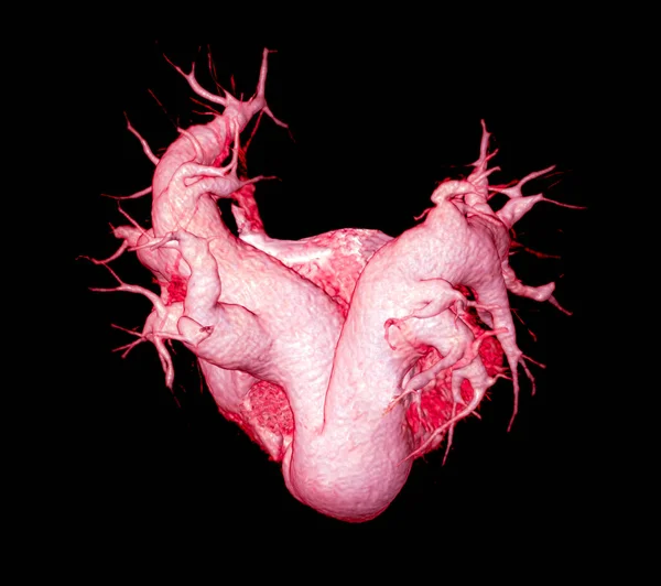 Cta肺动脉三维显像显示肺动脉分支 — 图库照片