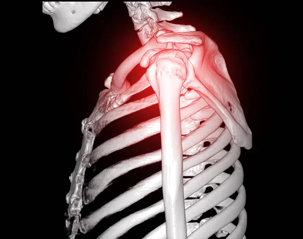 Ct肩関節骨折の場合における肩3Dレンダリングのボリュームレンダリング検査のコンピュータ断層撮影の3D — ストック写真