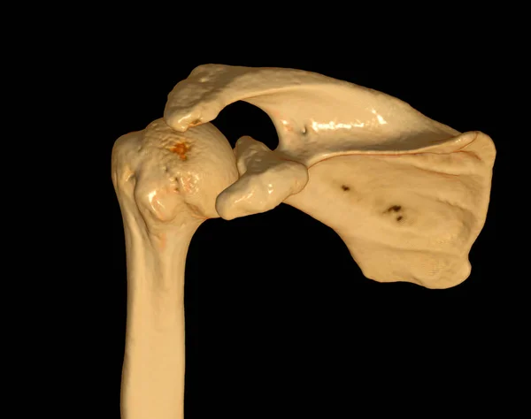 Shoulder Computed Tomography Volume Rendering Examination Shoulder Rendering Case Fracture — Fotografia de Stock