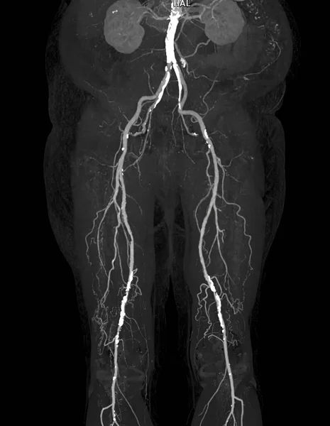 急性或慢性外周血管道炎合并股动脉病变的Cta股动脉径流图像分析 — 图库照片