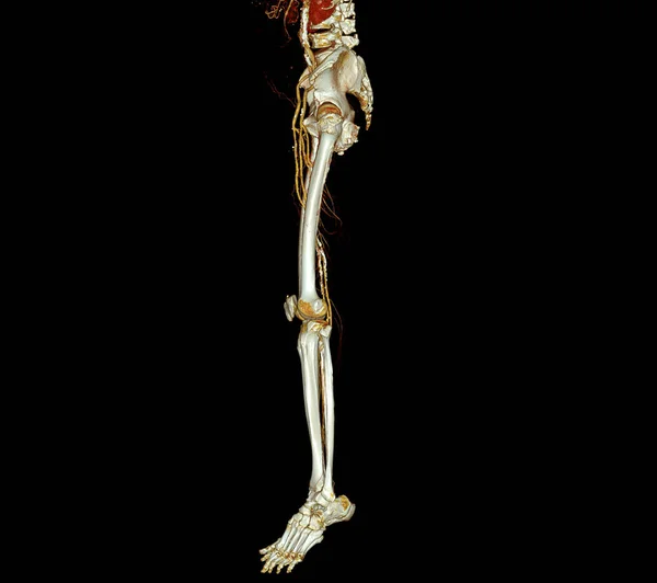 Cta大腿動脈が3Dレンダリング画像をオフに実行されます大腿動脈のプレゼンテーション急性または慢性末梢疾患 — ストック写真